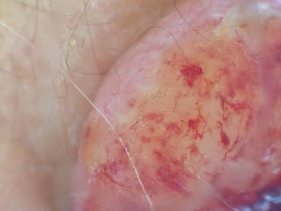 Figure 2: Dermoscopical image showing a yellowish background with erythematous areas, and polymorphic vascularization marked at the periphery of the lesion with hemorrhagic suffusions.