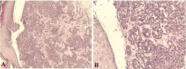 Figure 3: Histological examination with HES coloration ->Carcinomatous proliferation with pseudoglandular cavities: (A): low magnification G x 50. (B): high magnification G x 200.