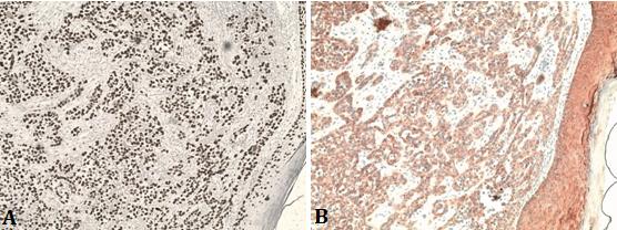 Figure 4: IHC Coloration G x 100->(A): P63: Diffuse nuclear marking. (B): CK5/6: Diffuse marking of tumor proliferation.