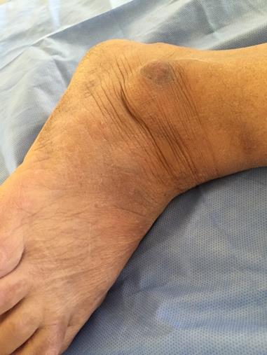 Figure 1: A 2 cm nodule of the external malleolus without any inflammatory signs.