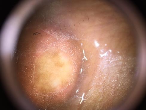 Figure 2: Dermoscopy showing yellowish area with an erythematous background.