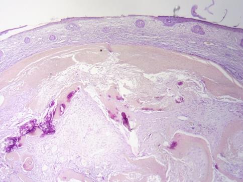 Figure 3: Microphotography showing a clear appearance of shadow cells with multiple calcifications (HE, 40X).