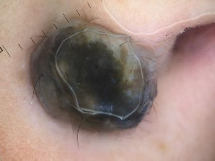 Figure 2: Dermoscopy showing a homogenous, brown- blue and globular pattern with emergence of some hair.
