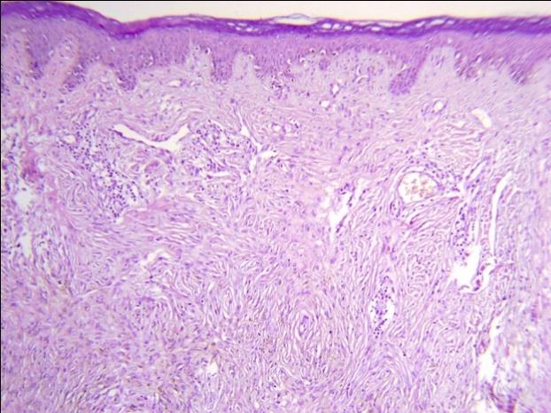 Figure 3: Deep penetrating naevi are characterized by plump fusiform melanocytes, without atypia.