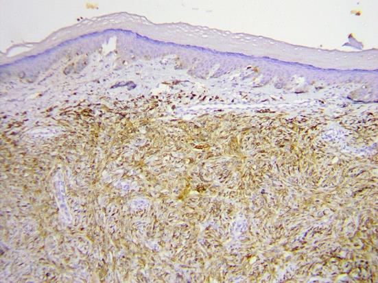 Figure 4: Immunohistochemical staining positive for S- 100 and HMB-45.