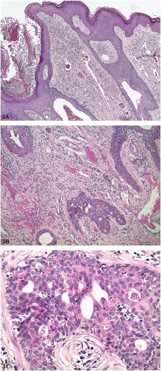 Figure 3: Histological sections of the tumor. Figure 3A: Proliferation at the dermoepidermal interface extending in tongues anastomosing in the dermis. (HES,×50).