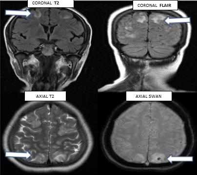 Figure 3: 24 year old postpartum women with h/o pre eclampsia, presented with one episode of seizure MRI brain reveals bilateral symmetrical T2/FLAIR hyperintensities involving bilateral frontoparietal region with a foci of hemorrhage in left parietal lobe-Diagnosis of Posterior Reversible Encephalopathy was made.
