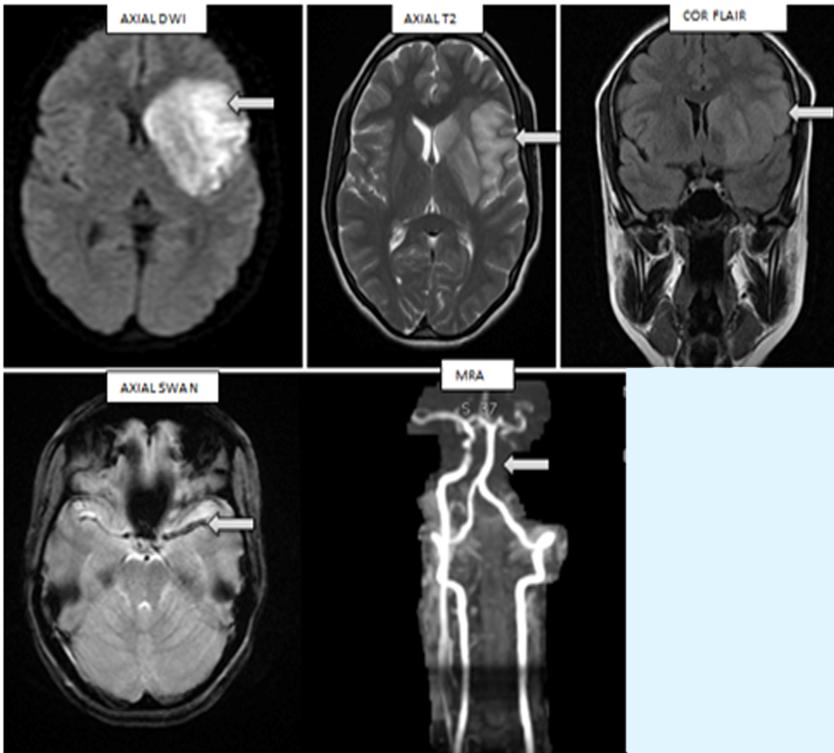 Figure 7: 25 year old woman with 9 months of amenorrhea with right sided weakness, Axial DWI, T2, Coronal T2 FLAIR, SWAN and MRA shows left MCA territory infarct secondary to thrombosis involving left ICA and MCA.