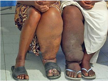 Figure 3: Man and wife with elephantiasis.