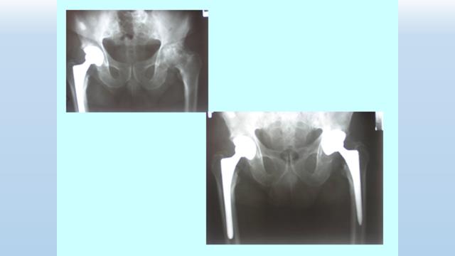Figure 1: Femoral head with an area of completely destroyed cartilage (arrows).