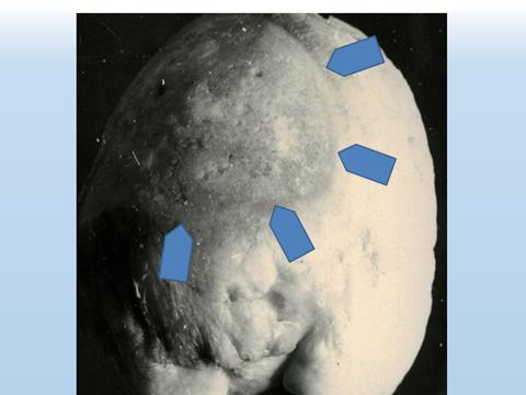 Figure 2: Photo of the final stage of endoprosthesis implantation procedure (photo by prof. T. Niedźwiedzki).