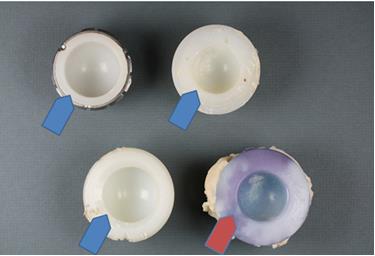 Figure 4: Studied acetabula. New acetabula that were unused for a long time (blue arrows). One of the acetabula taken out of the joint after a few years of functioning (with some fixing cement, red arrow).