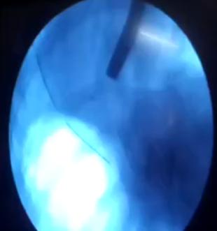 Figure 1: ICD on Left side fistulous opening Fistulogram.