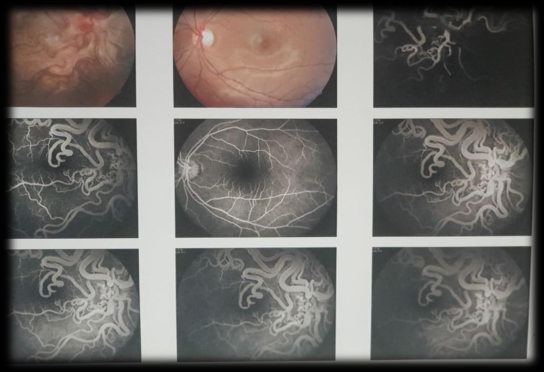 Figure 1: FFA of R/E revealed early filling and delayed emptying of anastomosing vessels but no leakage and no areas of capillary non-perfusion.
