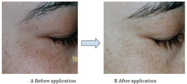 Figure 6: Effect of astaxanthin based cream on fine wrinkles under eyes and outer canth.
