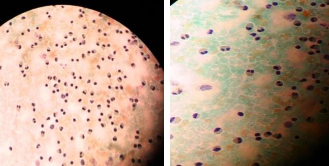Figure 1: Ascites fluid appearance in case 1 and 2 (Pap and Leishman stains 40 X).