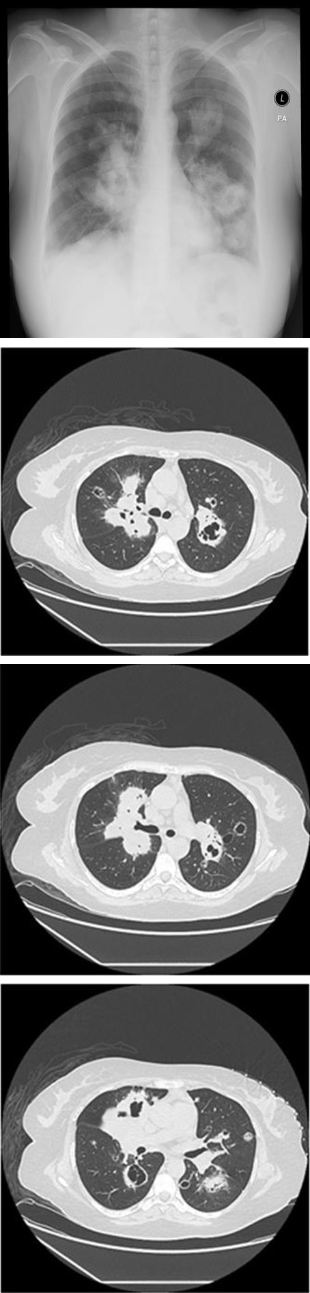 Figure 1: Bilateral innumerable lung nodules and masses.