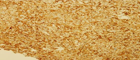 Figure 3: Section shows diffuse infiltration of dyscohesive large tumor cells with prominent nucleoli (H&E, X400).