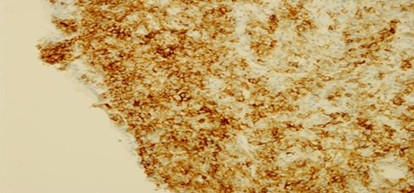 Figure 4: Section shows tumor cells are positive for CD45 (H&E, X200).