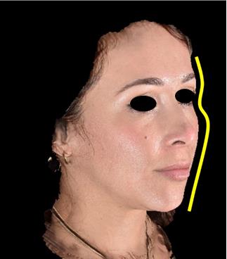 Figure 1: Ogee curve. External S shaped curve that outlines the facial contour in three quarters view.