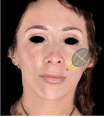 Figure 3: Any skin blebs were massaged down after administration.