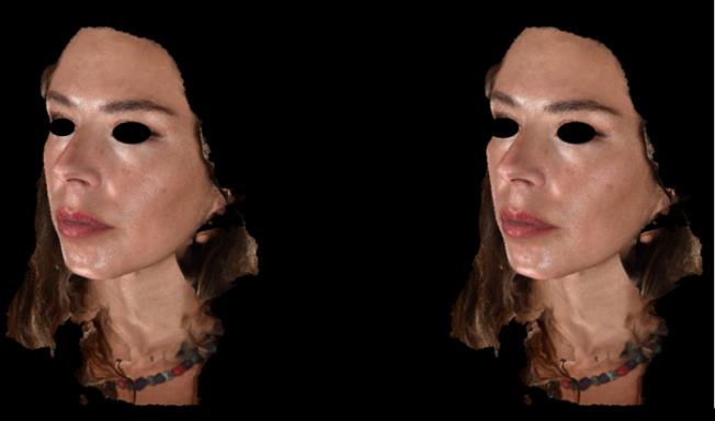 Figure 7: Female patient, 35y, Cheekbone Enhancement, Decoria voluma, 3mL total, Curved cannula technique.