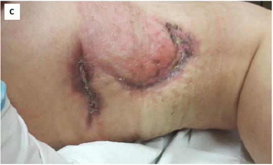 Figure 2: 2A: Day 42 - There is keratinization of original wound (green arrow), dressing was changed to polyester mesh impregnated with hydrocolloid, petroleum jelly and silver sulphadiazine particles. 2B: Day 54 - Gradual contraction is seen and dressing was continued with special coated dressing with hydrophobic properties. 2C: Day 100 - Full contraction and keratinization of the original PG ulcer.