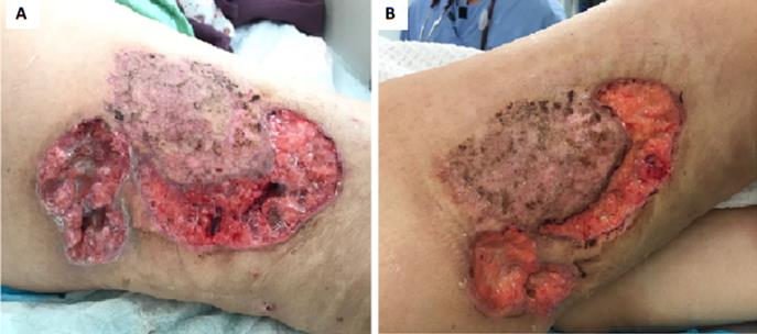 Figure 3: A: Special coated dressing with hydrophobic properties. B&C: Gentle removal with minimal adhesiveness reduces pain on dressings. D: Complete removal of dressings.