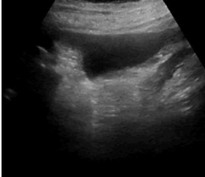 Figure 1: Free Fluid in Peritoneal Cavity.