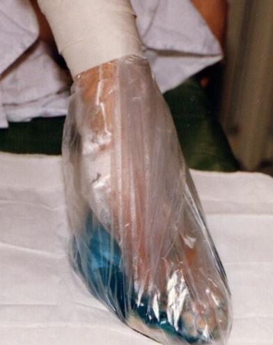 Figure 1: The foot submerged in an antiseptic solution, which is located in a plastic bag.