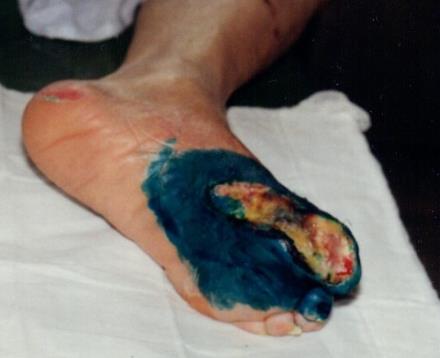 Figure 2: Foot of the patient after treatment in antibacterial Wednesday.