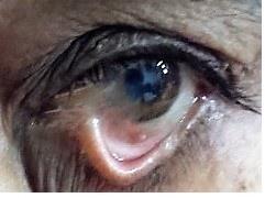 Figure 1: Preoperative photograph of the left eye showing pterygium with partial symblepharon.
