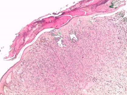 Figure 2: Pathological section of the biopsy of the mass in the left nipple showing a tumoral carcinomatous proliferation ulcerating the skin (50 x magnifications).