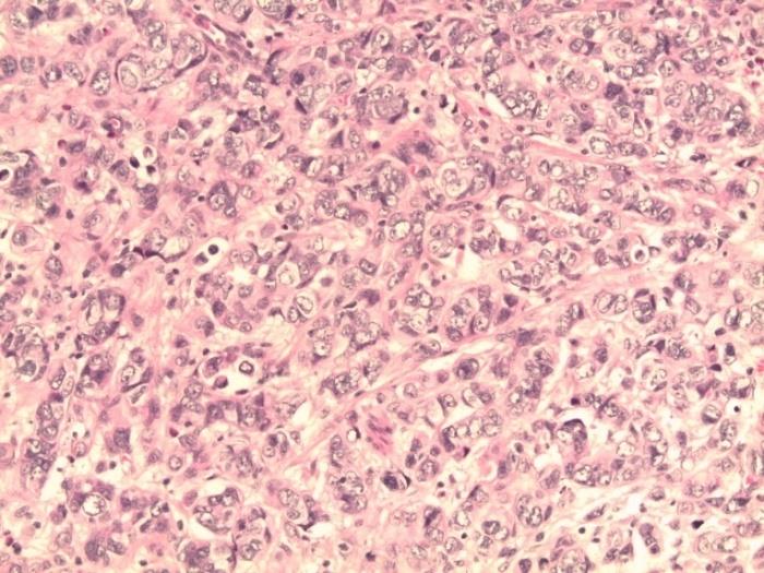 Figure 3: Histological section showing cords of globoid cells with marked atypia (200 x magnifications).