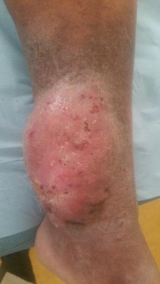 Figure 1: Clinical image of the violaceous tumor of the lower extremity.