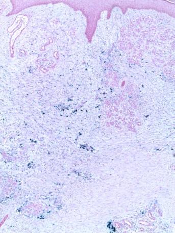 Figure 4: Perls staining G x 50 -> Heme deposits colored blue by the Perls.