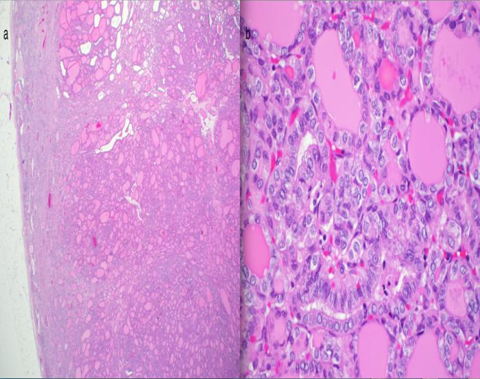 Figure 2: (a) Low magnification of the renal tumor showing follicular architecture (H&E x2) (b) Papillary carcinoma nuclear features with over lapping, nuclear clearing and grooves. Pseudo-inclusions were also found (H&E x40). On follow-up 6 months later, the patient was asymptomatic and most likely in complete remission of her thyroid cancer.