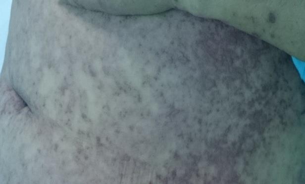 Figure 2: Disseminated Dermatosis with Papules.