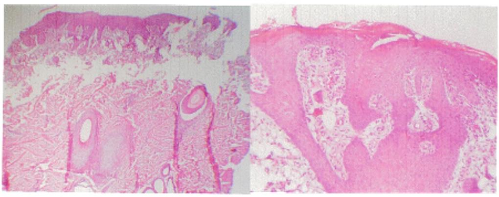 Figure 3: (Left) Cultured Keratinocytes. Note irregular epithelization with epidermis detachment. (Right) Stem-cells. Complete epithelization, epidermal hyperplasia.