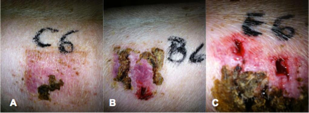 Figure 5: Clinical findings. (A) Stem-cell patch. (B) Semi-occlusive dressing. (C) Cultured Keratinocytes.