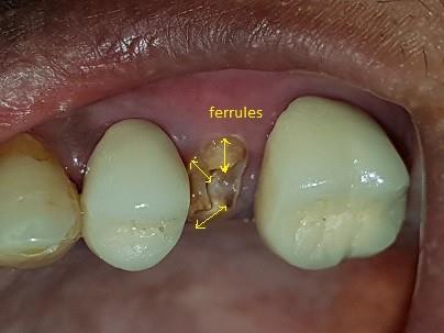 Figure 1: Initial case crown.