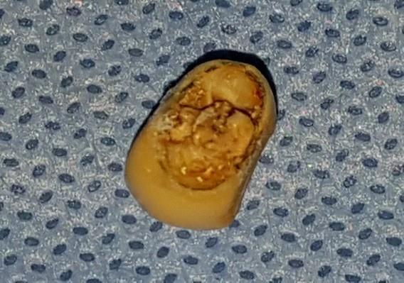 Figure 2: Pre-existing metal ceramic crown with fractured abutment.