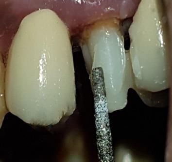 Figure 7: Composite core build up.