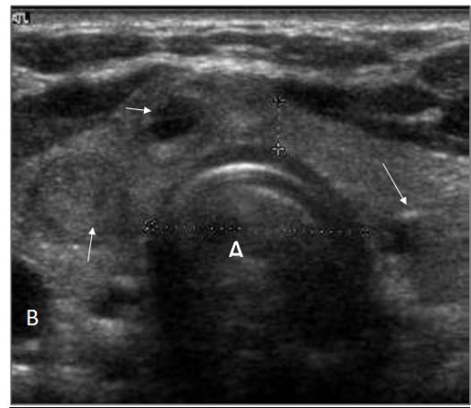 Figure 1: transverse section (passing by the isthmus) of the thyroid objectivizing a multinodular goiter. We notice an expansion of the gland with many nodules (arrows), changing in number and height, separated from normal parenchyma. A: Windpipe; B: internal carotid (picture: ORL department university hospital of Cocody)