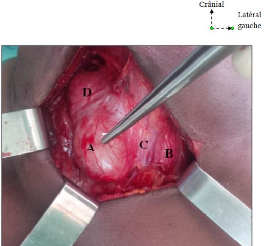 Figure 3: operating view of a thyroid nodule from the left lobe. A: Nodule; B: Left Lobe; C: Isthmus; D: Right Lobe (Picture: ORL department of Cocody)