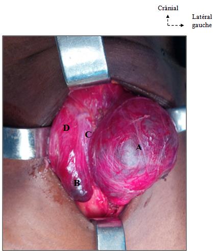 Figure 4: Per-operative aspect of a nodulo-multicystic goiter. A: Numerous cysts; B: Voluminous left nodule; C: Isthmus held by goiter; D: Right lobe (Picture: ORL department of Cocody) Gentle palpation has allowed us to specify consistency, number and borders of thyroid nodule(s) compared to adjacent tissue. Ablation of the mass has allowed us to estimate the size (measurements) with a sterile tape measure. We have noted vertical and horizontal diameters of the thyroid nodule(s) in all the cases. The tape measure has been placed over the right and left cranial pole of each thyroid lobe (Figure5 & 6).