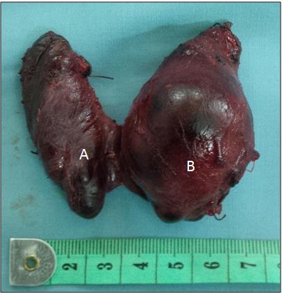 Figure 6: Surgical specimen after total thyroidectomy demonstrating a nodulo-multicystic goiter. A: Numerous cysts of the right lobe; B: Voluminous left nodule; C: Isthmus held by the goiter (Picture: ORL department of Cocody) The operative treatment taking into account the different operative macroscopic criteria suspected of malignancy or benignancy (Table 3 & 4), has consisted in either a: lobo-isthmectomy, lobectomy, subtotal or partial thyroidectomy or a total thyroidectomy. Total thyroidectomy with radical and/ or functional lymph node curettage has been completed before a thyroid cervical swelling associated with latero-cervical adenopathies and aspiration cytology malignancy signs.