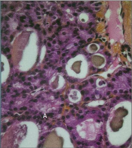 Figure 8: cytological aspect of a thyroid vesicular adenoma (A: colloid); (Picture: Pathology department, University Hospital of Cocody)