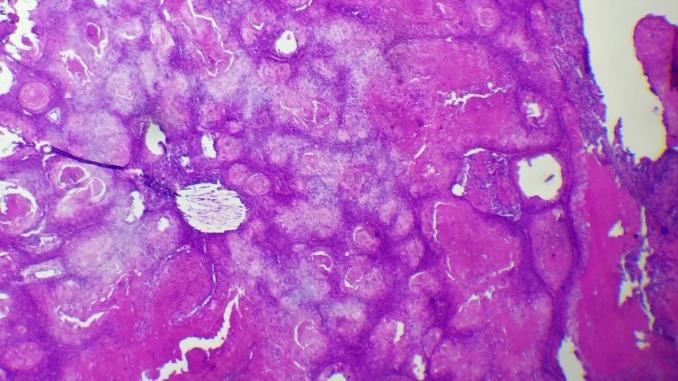 Figure 3: Histology of PTC. A: Benign PTC. Multilobular proliferative epithelial masses. (HE × 100). B: Malignant PTC. Trichilemmal keratinization with carcinomatous proliferation. (HE × 400).