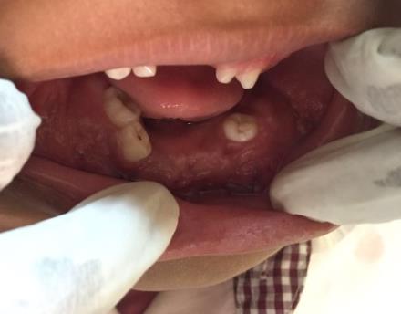 Figure 2: Intra oral view shows bucco-lingual mandibular swelling with displaced & unerupted teeth.